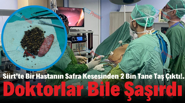 Siirt’te Bir Hastanın Safra Kesesinden 2 Bin Tane Taş Çıktı!. Doktorlar Bile Şaşırdı